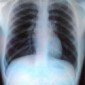 A Simple Blood Test Reveals Rare Lung Disease