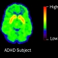 ADHD Changes Brain Development Patterns in Kids