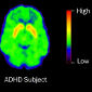 ADHD and DESR May Be Linked, Transmissible