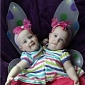 Allison and Amelia Tucker: Conjoined Twins Separated at Eight Months