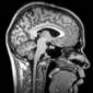 Alzheimer's-Responsible Protein Spreads Throughout the Brain