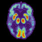 Alzheimer's Imaging Test Will Soon Become a Reality