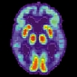 Alzheimer’s Risk Can Be Revealed in Brain Scan