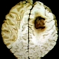 Anti-Nausea Drugs Used to Halt the Growth of Brain Tumors