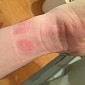 Apple Watch Causes Skin Rashes for Some Users - Photos