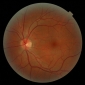 Artificial Retina Prototypes Help Blind People See