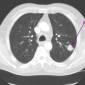 Better Cooperation Among Doctors to Improve Lung Cancer Outcome