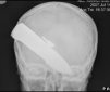 Boy Survives a Skull Stabbing with a 3 in (7.5 cm) Long Knife