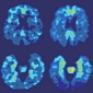Brain Scan Can Predict Dementia Risks
