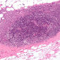 Breast Cancer Protein Scrutinized