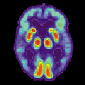 Clinical Diagnostic Criteria for Alzheimer's Disease Revised