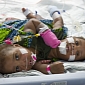 Conjoined Twins Separated in Groundbreaking Surgery
