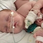 Conjoined Twins Undergo Major Surgery in Texas, Are Separated