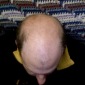 Cure for Baldness Underway