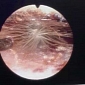 Dandelion Found Growing in Child's Ear Canal