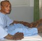 Dede, The Tree Man, Operated and Back for Love