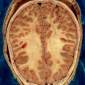 Deep-Brain Electrode Stimulation Boosts Neuron Growth