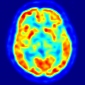 Dementia Can Be Unmasked with PET Scans