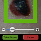 Detect Skin Cancer with New iPhone App from Health Discovery