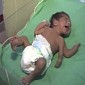 Doctors Operate on Baby Born with 3 Arms, Remove the Extra Limb