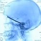 Doctors Remove 3-Inch (8-Centimeter) Nail from Man's Head
