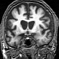 Excessive Iron Concentrations Lead to Neurodegenerative Dementias