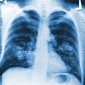 Gene Driving Lung Cancer Development Found