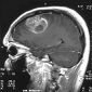 Genes Responsible for Brain Cancer Found