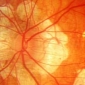 Genetic Roots of Blindness Teased Out in New Study