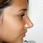 Girl, 13, Gets Nose Job to Avoid Bullying in School