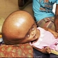 Girl with Giant Double-Sized Head Successfully Undergoes Surgery