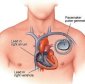The Heart's Natural Pacemaker