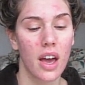 How Acne-Scarred Girl Is a Gorgeous Model – Video