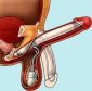 How Does the Inflatable Penis Prosthesis Work?