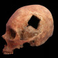 Incas Performed Complex Skull Surgeries