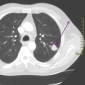 Inexperienced Surgeons Increase Lung Cancer Mortality Rates