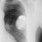 Injectable Pacemaker Developed at Medtronic