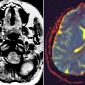 Innovative Algorithm Tracks Diseased Areas of the Brain