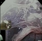 Kidney Removed Via Vagina