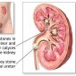 Kidney Stone: Causes and Treatments
