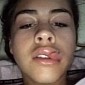 #KylieJennerChallengeGoneWrong Shows Gruesome Results of the #KylieJennerChallenge - Photo