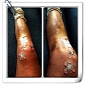 Lindsey Vonn Shows Photo of Badly Injured Leg, Pic Goes Viral
