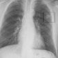 Lung Cancer Reveals 480 New Biomarkers