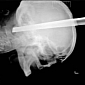 Man Gets Stool Leg Embedded in His Skull, Stabbing His Brain