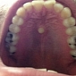 Man Has Tooth Growing on Roof of His Mouth