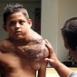 Massive Tumor Successfully Removed from Boy's Neck [AP]