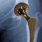 Metal-on-Metal Hip Implants Cause Soft Tissue Damage, FDA Says