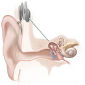 New Cochlear Implant Can Benefit Children