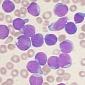 New Drug Shows Promise for Treating Leukemia