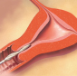 New Procedure Removes Appendixes Through Vagina